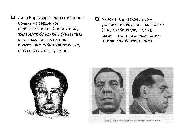 q Лицо Корвизара - характерно для больных с сердечной недостаточность. Оно отечное, желтовато-бледное с