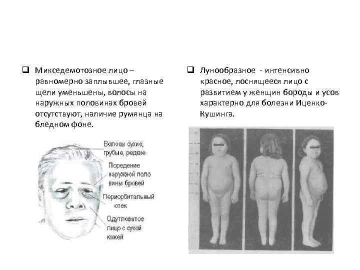 q Микседемотозное лицо – равномерно заплывшее, глазные щели уменьшены, волосы на наружных половинах бровей