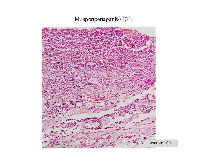 Увеличение 40. Перифокальное воспаление микропрепарат. Микропрепарат кожи сосуды. Хронический геморрой микропрепарат. Увеличение микропрепарат.