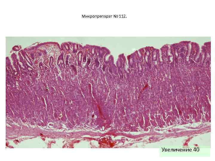 Увеличение 40. Гнойный хориоамнионит микропрепарат. Фибринозный эндокардит микропрепарат. Гангрена кишки микропрепарат. Хориоамнионит микропрепарат.