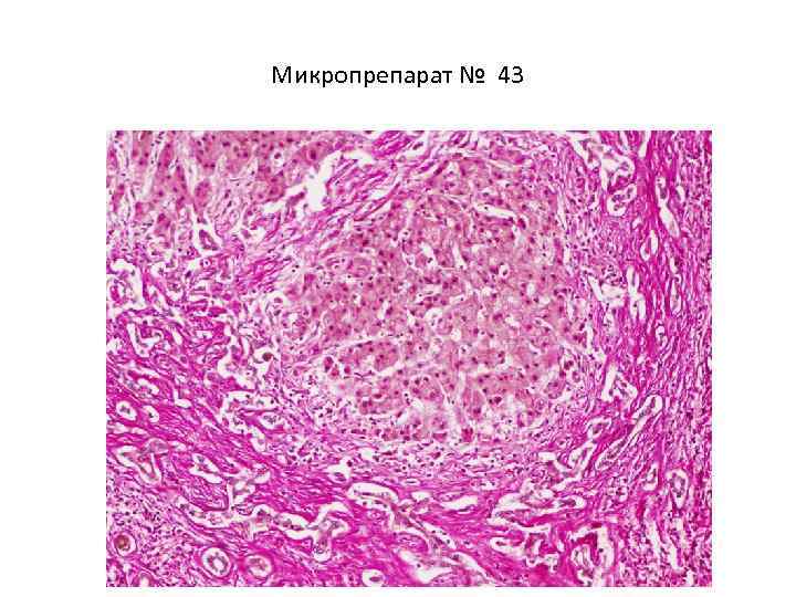 Абсцесс печени микропрепарат рисунок