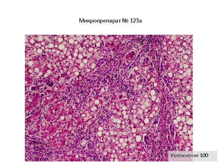 Холестаз смешанного типа микропрепарат рисунок