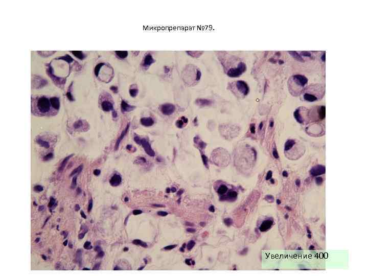 Увеличение 40. Увеличение микропрепарат. Гнойный омфалит микропрепарат. Омфалит микропрепарат. Гиперкератоз пойкилоцитоз митозы микропрепарат.