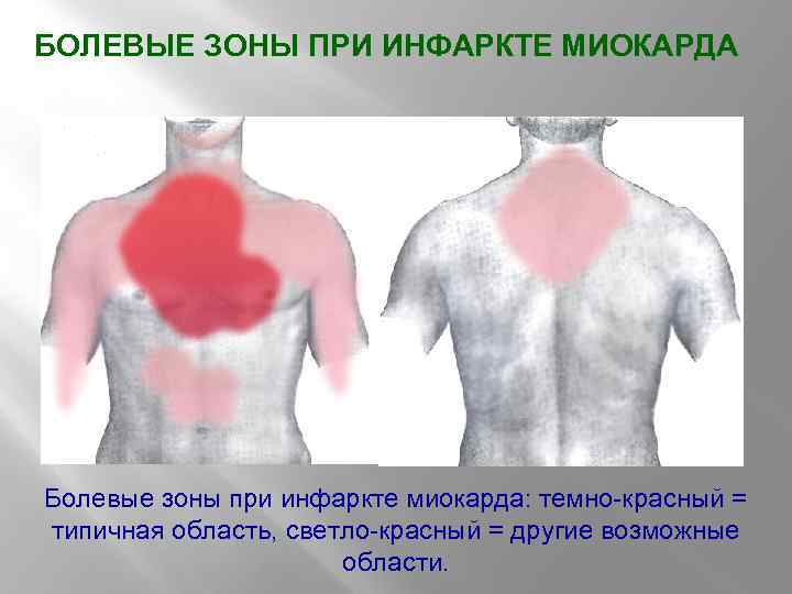 БОЛЕВЫЕ ЗОНЫ ПРИ ИНФАРКТЕ МИОКАРДА Болевые зоны при инфаркте миокарда: темно-красный = типичная область,