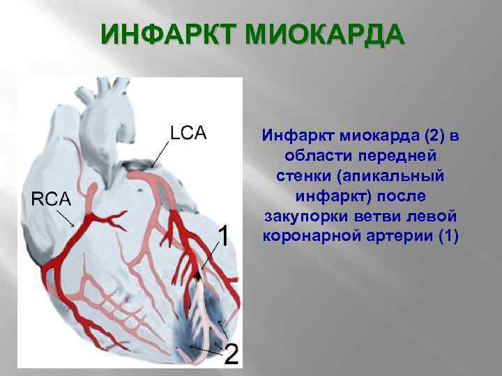 ИНФАРКТ МИОКАРДА Инфаркт миокарда (2) в области передней стенки (апикальный инфаркт) после закупорки ветви