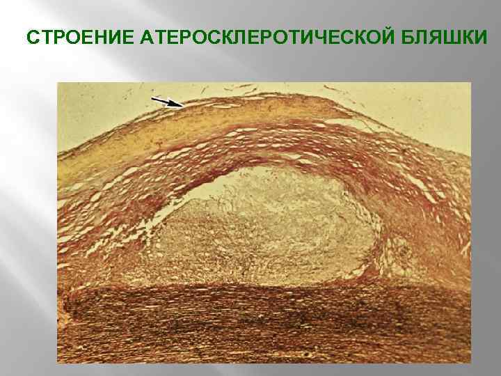 СТРОЕНИЕ АТЕРОСКЛЕРОТИЧЕСКОЙ БЛЯШКИ 