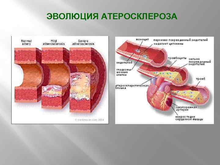 ЭВОЛЮЦИЯ АТЕРОСКЛЕРОЗА 