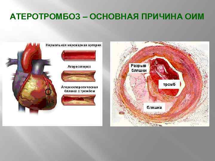 АТЕРОТРОМБОЗ – ОСНОВНАЯ ПРИЧИНА ОИМ 
