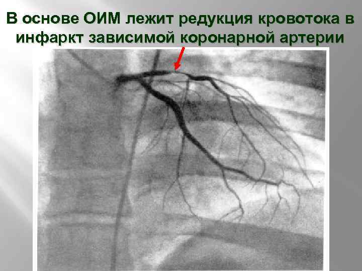 В основе ОИМ лежит редукция кровотока в инфаркт зависимой коронарной артерии 