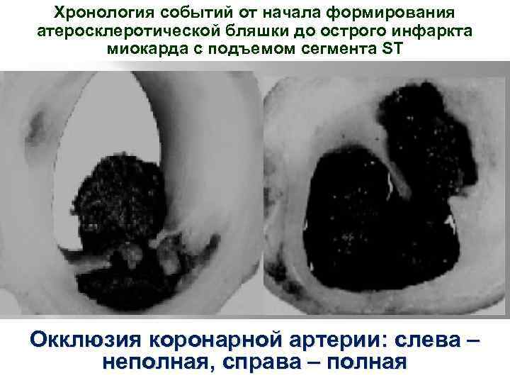 Хронология событий от начала формирования атеросклеротической бляшки до острого инфаркта миокарда с подъемом сегмента
