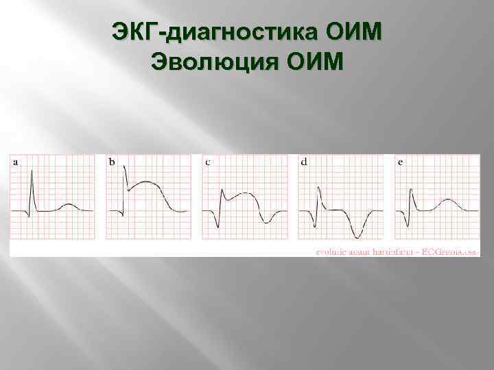 ЭКГ-диагностика ОИМ Эволюция ОИМ 