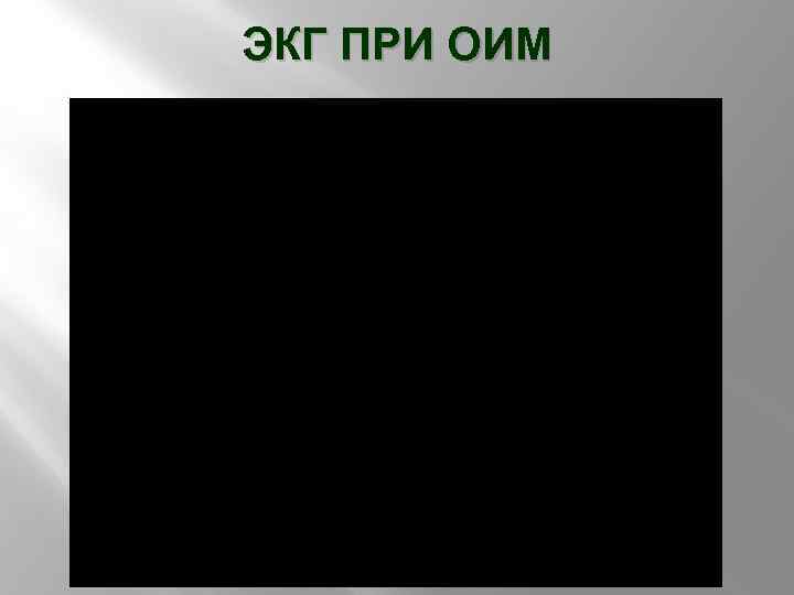 ЭКГ ПРИ ОИМ 