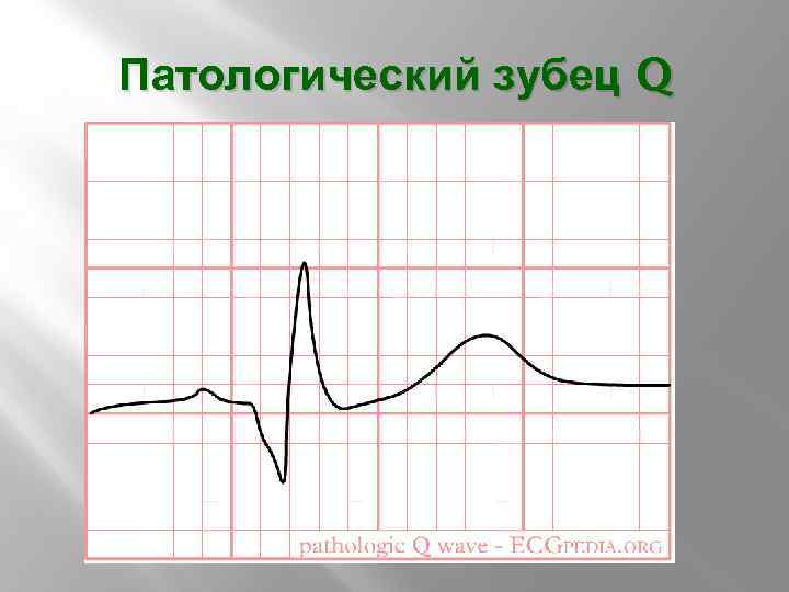 Патологический зубец q