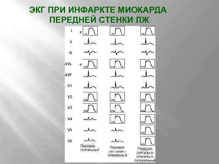 ЭКГ ПРИ ИНФАРКТЕ МИОКАРДА ПЕРЕДНЕЙ СТЕНКИ ЛЖ 