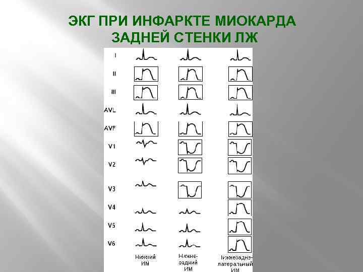 ЭКГ ПРИ ИНФАРКТЕ МИОКАРДА ЗАДНЕЙ СТЕНКИ ЛЖ 