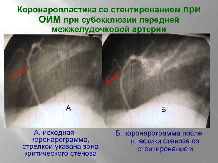 Коронаропластика со стентированием при ОИМ при субокклюзии передней межжелудочковой артерии А А. исходная коронарограмма,