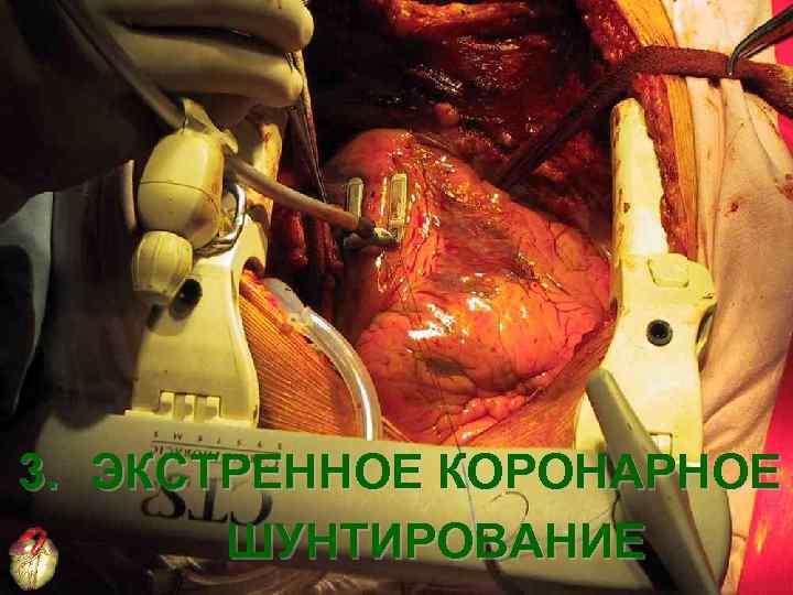 3. ЭКСТРЕННОЕ КОРОНАРНОЕ ШУНТИРОВАНИЕ 