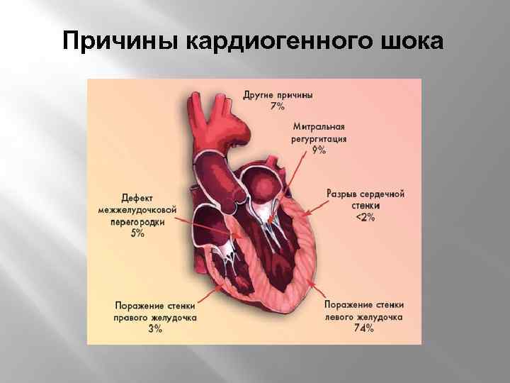 Кардиогенный шок при остром инфаркте миокарда