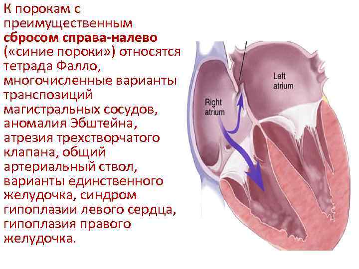 Порок трикуспидального клапана