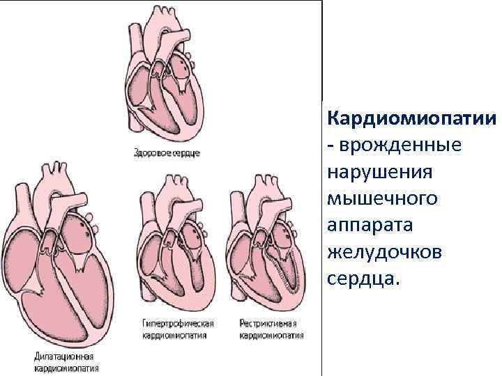 Кардиомиопатии - врожденные нарушения мышечного аппарата желудочков сердца. 