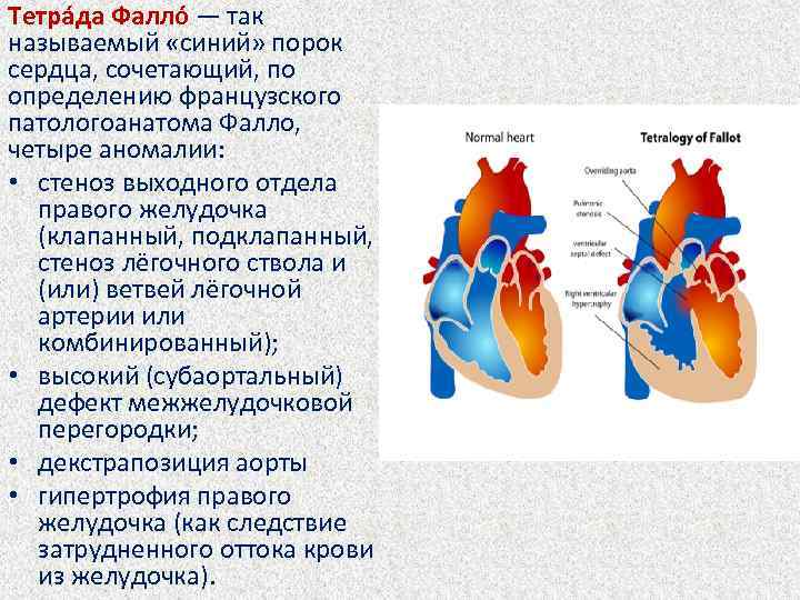 Тетра да Фалло — так называемый «синий» порок сердца, сочетающий, по определению французского патологоанатома