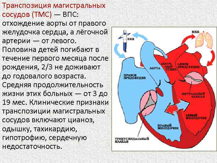 Транспозиция магистральных артерий презентация