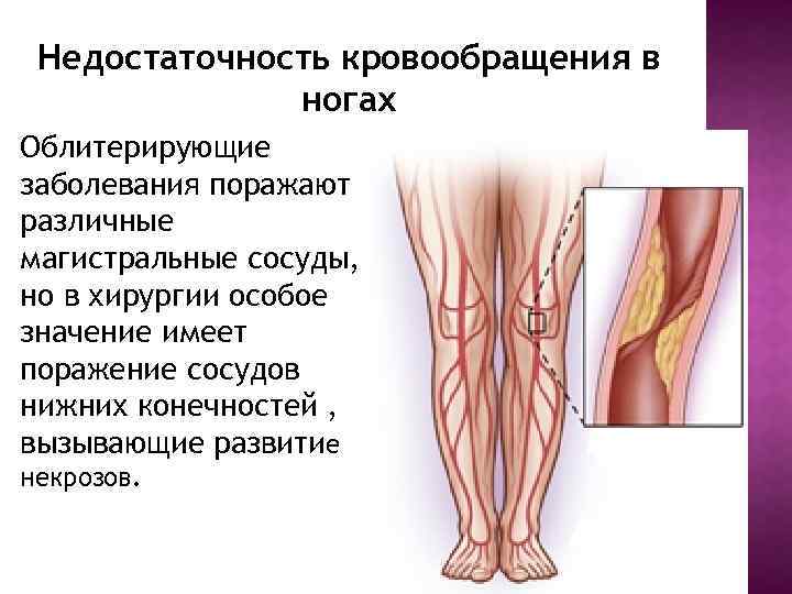 Недостаточность кровообращения в ногах Облитерирующие заболевания поражают различные магистральные сосуды, но в хирургии особое