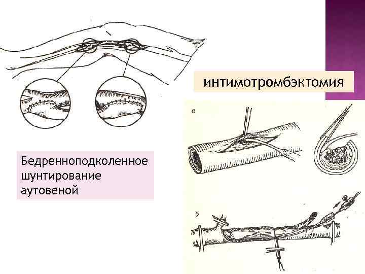 интимотромбэктомия Бедренноподколенное шунтирование аутовеной 