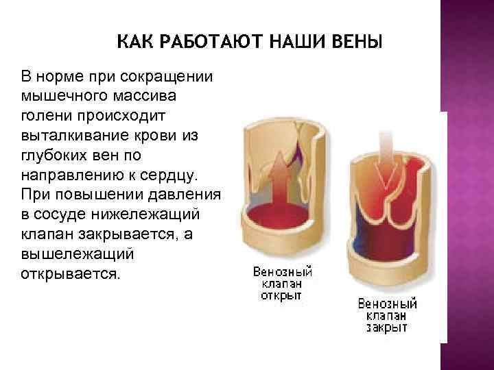 КАК РАБОТАЮТ НАШИ ВЕНЫ В норме при сокращении мышечного массива голени происходит выталкивание крови