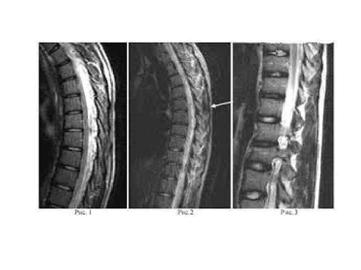 Грыжа позвоночника грудного отдела фото