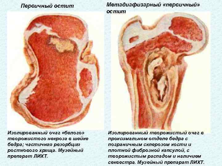 Первичный остит Изолированный очаг «белого» творожистого некроза в шейке бедра; частичная резорбция росткового хряща.