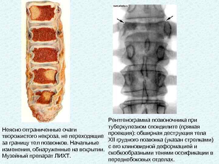 Спондилит. Бехтерева спондилит деструкция. Спондилит поясничного отдела позвоночника рентген. Туберкулез спондилит позвоночника. Спондилит поясничного отдела позвоночника что это такое.