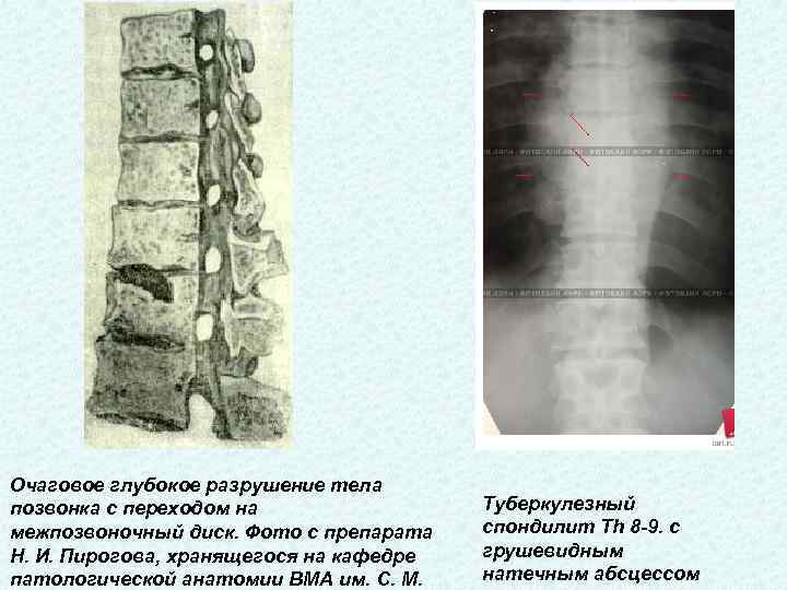 Очаговое глубокое разрушение тела позвонка с переходом на межпозвоночный диск. Фото с препарата Н.