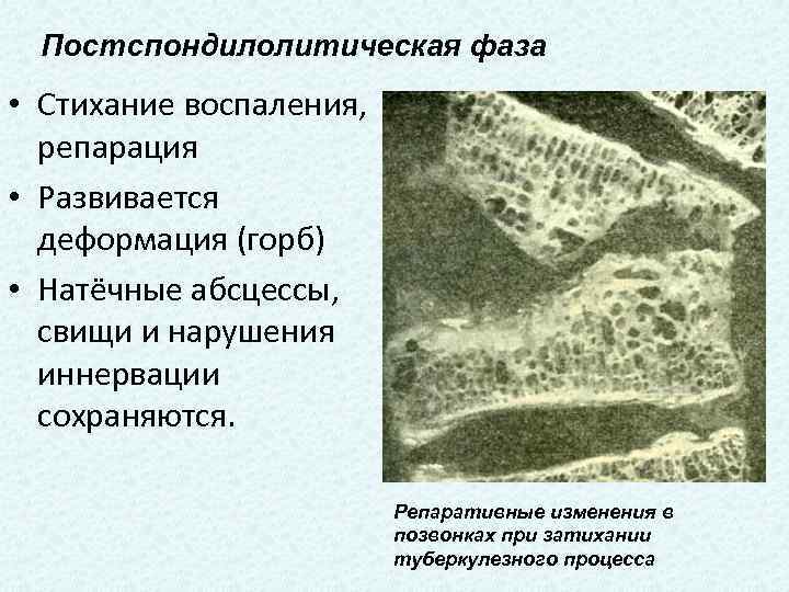 Постспондилолитическая фаза • Стихание воспаления, репарация • Развивается деформация (горб) • Натёчные абсцессы, свищи