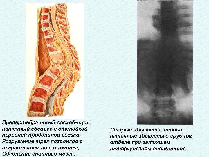 Превертебральный восходящий натечный абсцесс с отслойкой передней продольной связки. Разрушение трех позвонков с искривлением