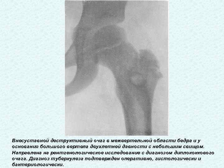 Обызвествление мышцы бедра