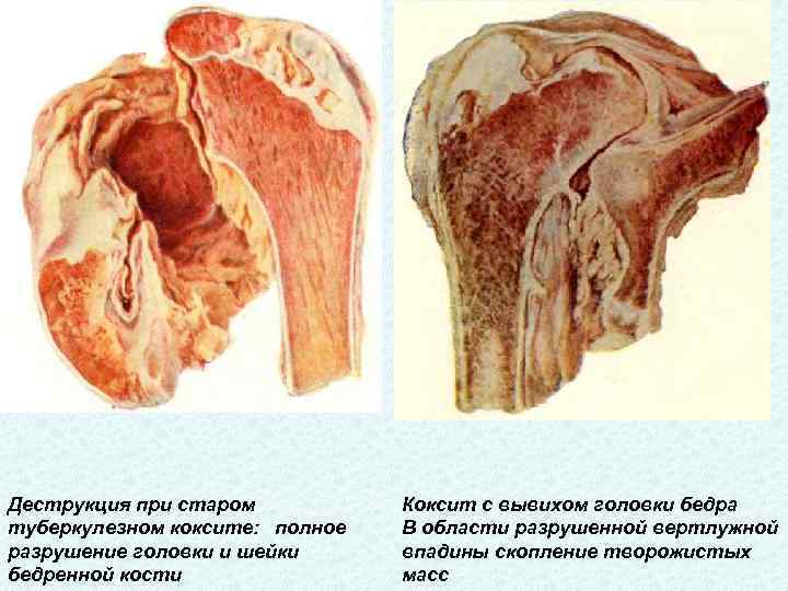 Деструкция при старом туберкулезном коксите:  полное разрушение головки и шейки бедренной кости Коксит с