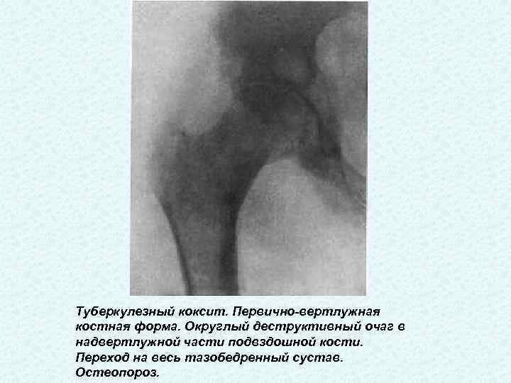 Туберкулезный коксит. Первично-вертлужная костная форма. Округлый деструктивный очаг в надвертлужной части подвздошной кости. Переход