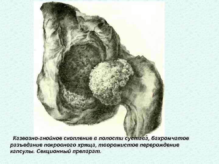  Казеозно-гнойное скопление в полости сустава, бахромчатое разъедание покровного хряща, творожистое перерождение капсулы. Секционный препарат.