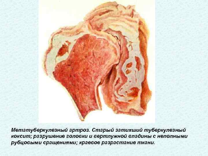 Метатуберкулезный артроз. Старый затихший туберкулезный коксит; разрушение головки и вертлужной впадины с неполными рубцовыми