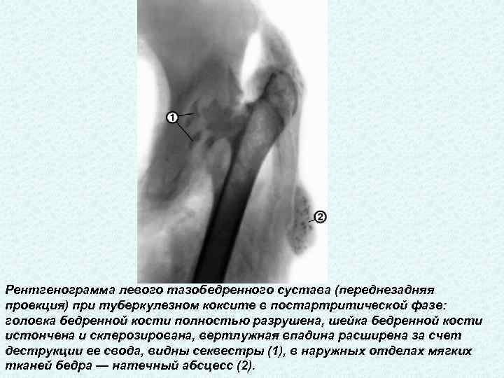 Рентгенограмма левого тазобедренного сустава (переднезадняя проекция) при туберкулезном коксите в постартритической фазе: головка бедренной