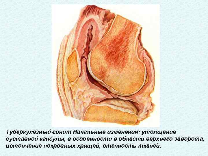 Туберкулезный гонит Начальные изменения: утолщение суставной капсулы, в особенности в области верхнего заворота, истончение