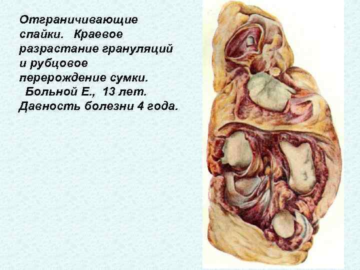 Отграничивающие спайки.  Краевое разрастание грануляций и рубцовое перерождение сумки.  Больной Е. , 13 лет.