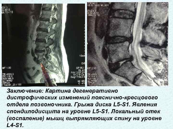 Мр картина нарушения статики