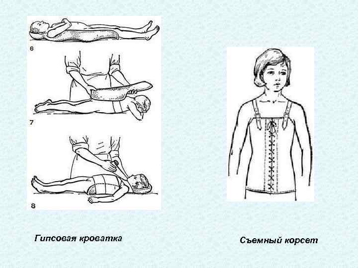 Гипсовая кроватка Съемный корсет 