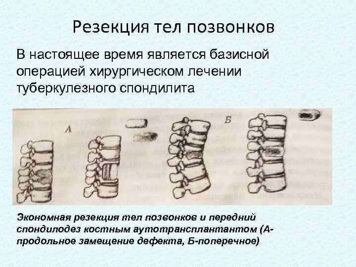 Резекция тел позвонков В настоящее время является базисной операцией хирургическом лечении туберкулезного спондилита Экономная