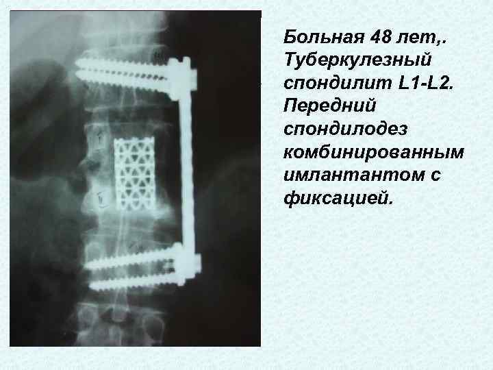 Больная 48 лет, . Туберкулезный спондилит L 1 -L 2. Передний спондилодез комбинированным имлантантом