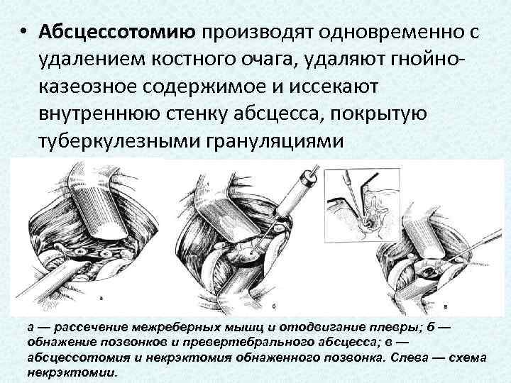  • Абсцессотомию производят одновременно с удалением костного очага, удаляют гнойноказеозное содержимое и иссекают