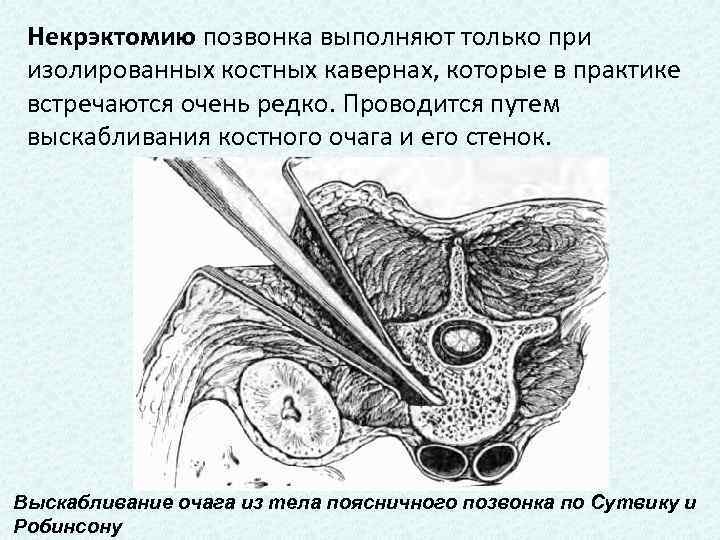 Некрэктомию позвонка выполняют только при изолированных костных кавернах, которые в практике встречаются очень редко.