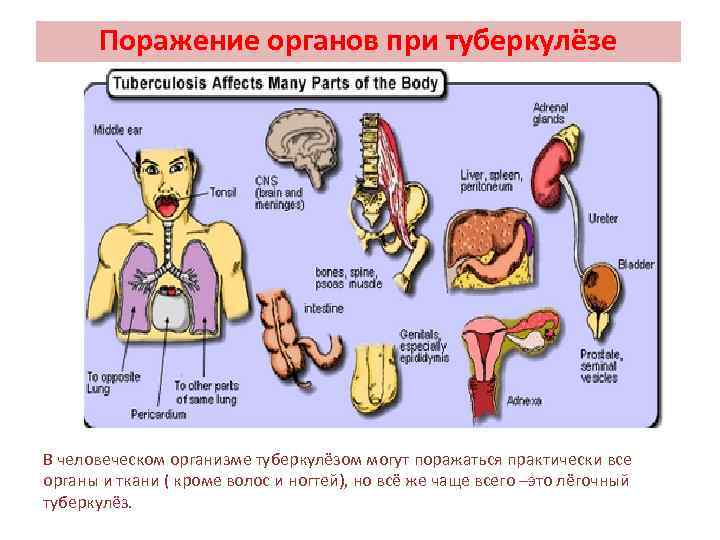 Поражение органов при туберкулёзе В человеческом организме туберкулёзом могут поражаться практически все органы и